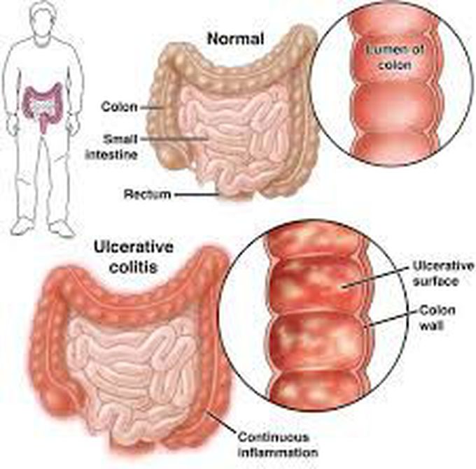 Causes of ulcerative colitis