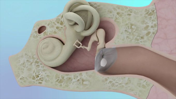 Eardrum Hole Surgery  - Transcanal Tympanoplasty