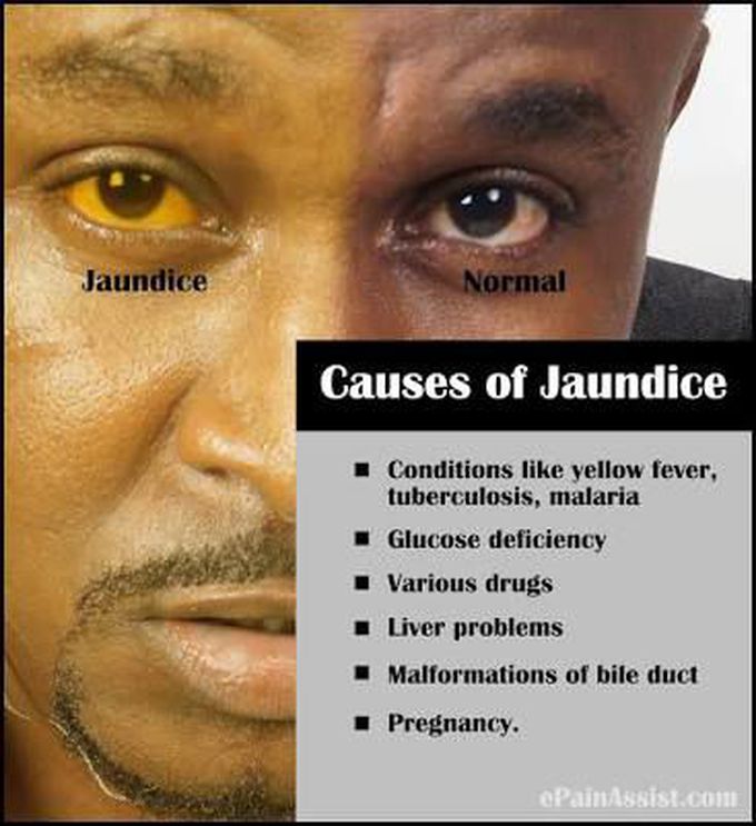 Jaundice