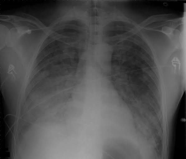 Acute Respiratory Distress Syndrome - MEDizzy