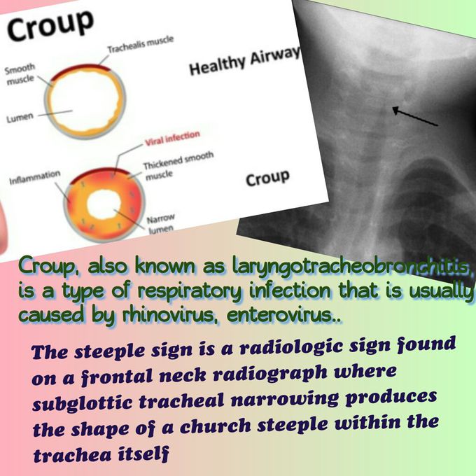 Croup