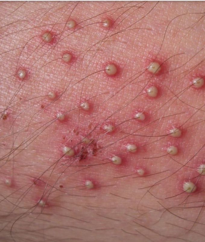 Folliculitis, caused by staphylococcus aureus