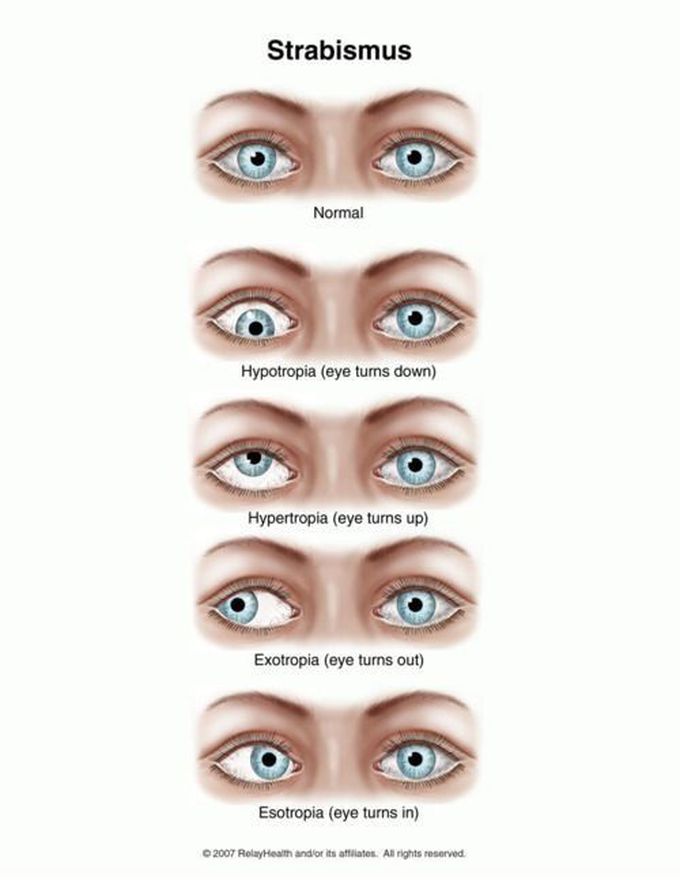 Strabismus