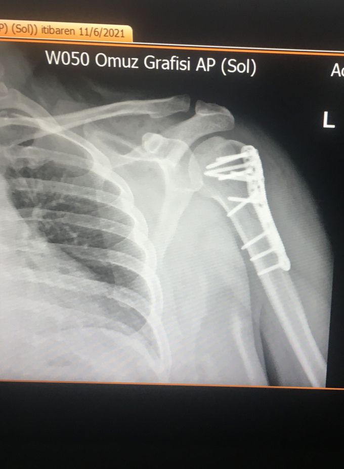 Shoulder operation