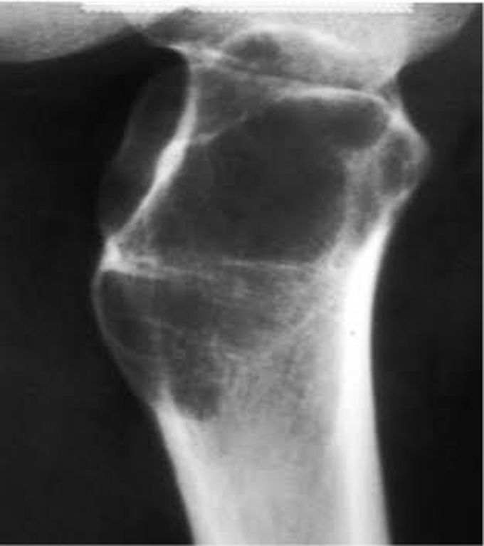 Aneurysmal bone cyst