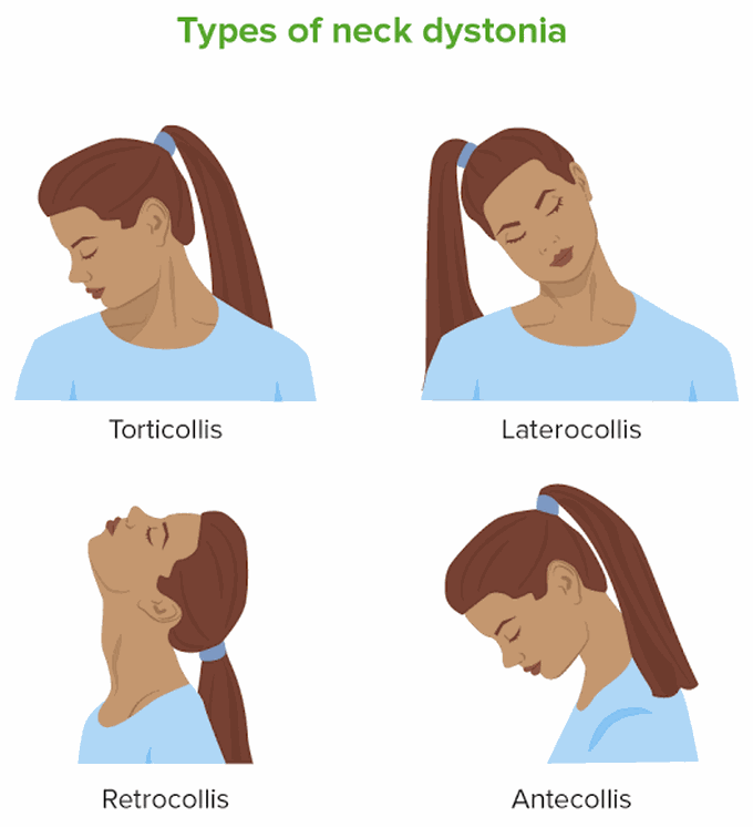 Types of neck dystonia