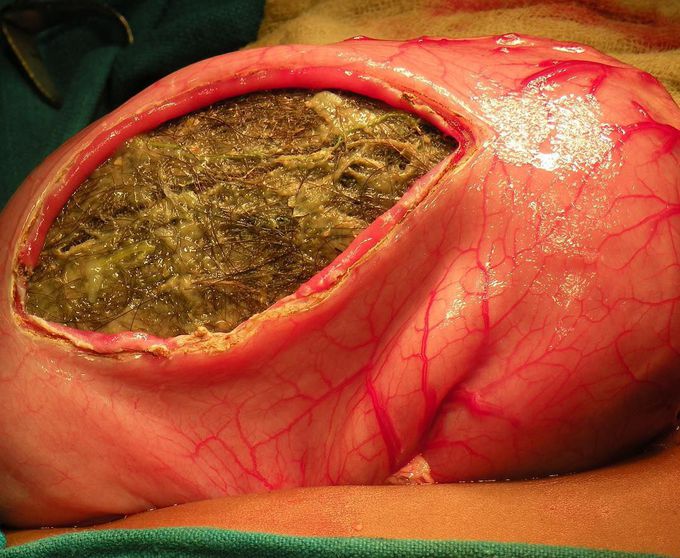 Trichobezoar removed from the stomach of a 5-year-old female child