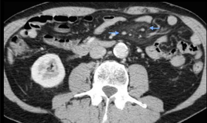 A 65 yrs man presented to the hospital with abdominal mass and pain. In the CT we have found this.