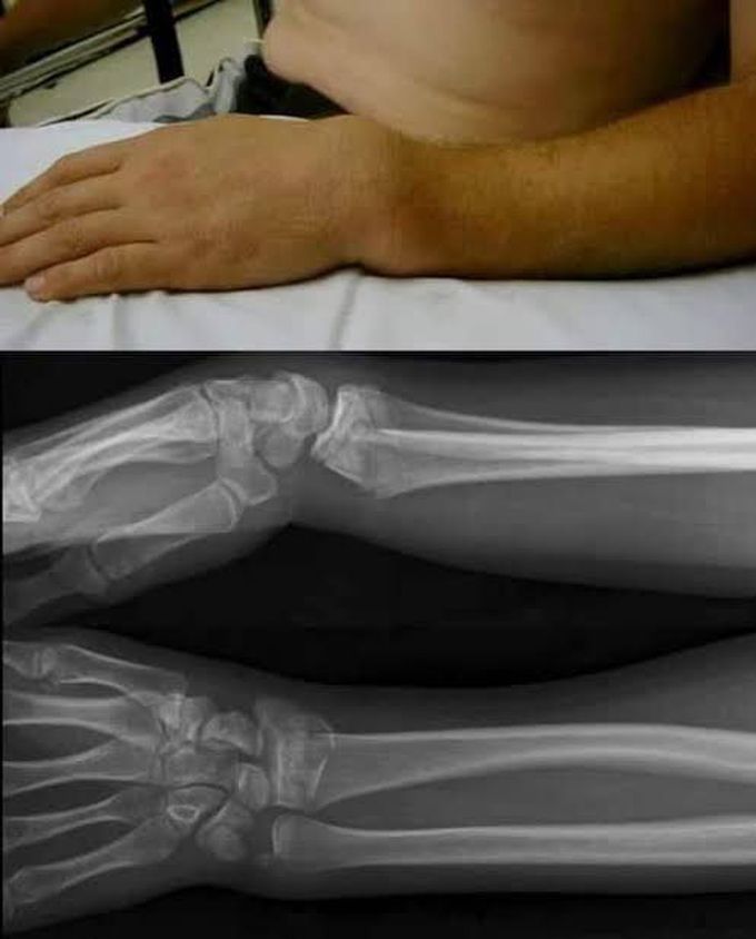 Colles fracture