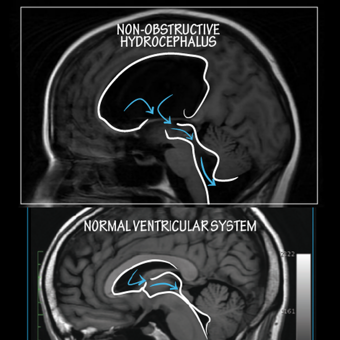 Communicating vs Non-communicating Hydrocephalus