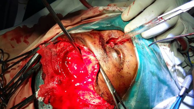 Operative Video of Penetrating Brain Injury