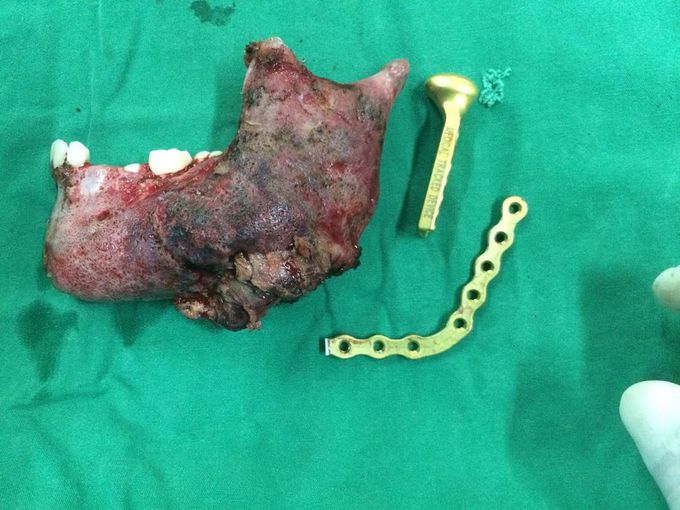 The left mandibula was ressected and change with reconplate and condylar plate...