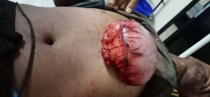 Stomach  out from horizontal cutted incised wound from below last rib