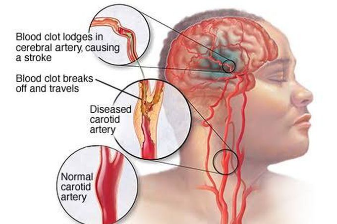 What is stroke?