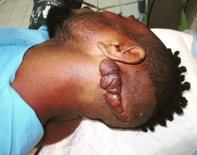 Keloid Scar