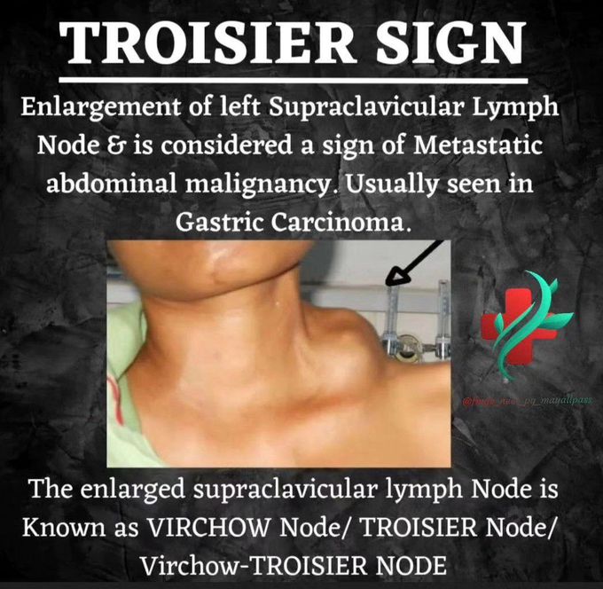 Troisier Sign