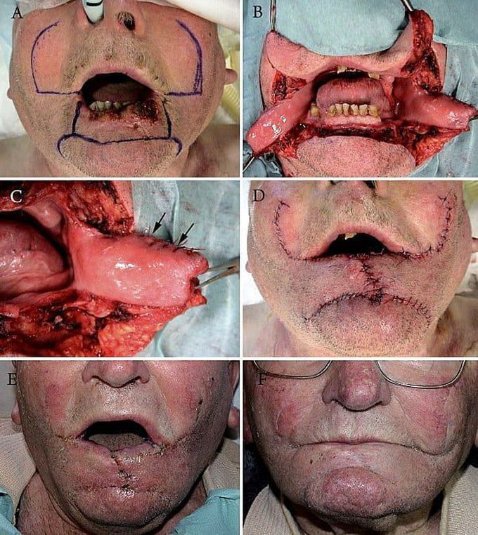 Lower lip epidermoid carcinoma