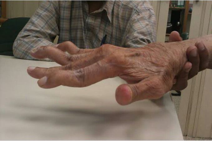 Swan neck deformity