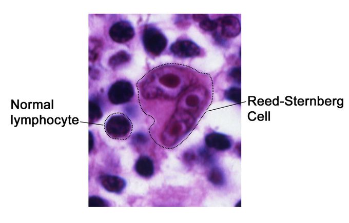 Hodgkin's lymphoma (microscopic view)