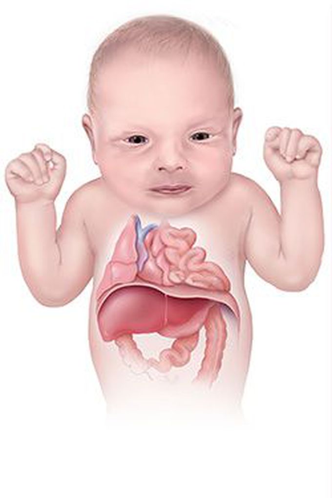 Diaphragmatic Hernia