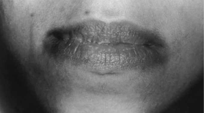 Perioral melanosis