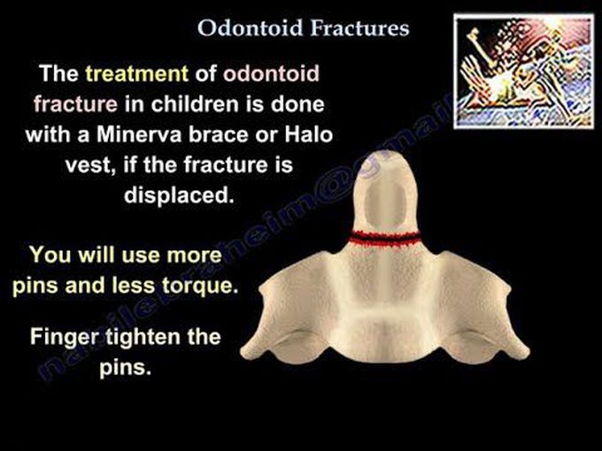 Odontoid Fractures