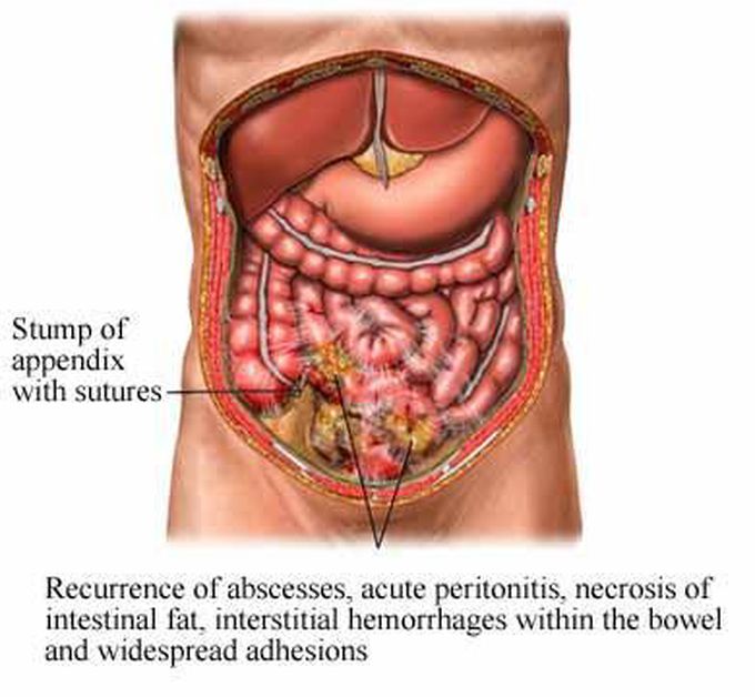 Prevention from peritonitis