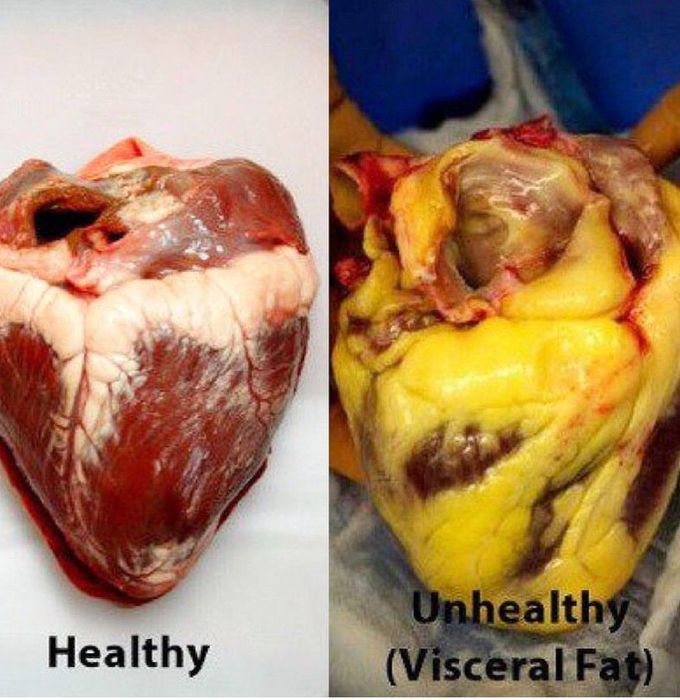 visceral fat