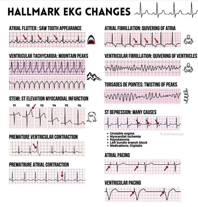 EKG Changes