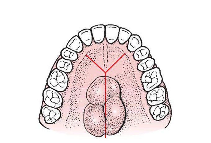 Y incision