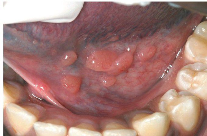 Lymphoid Hyperplasia