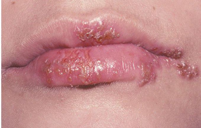 Herpes Labialis