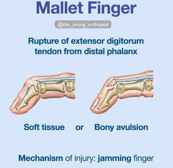 Mallet Finger I