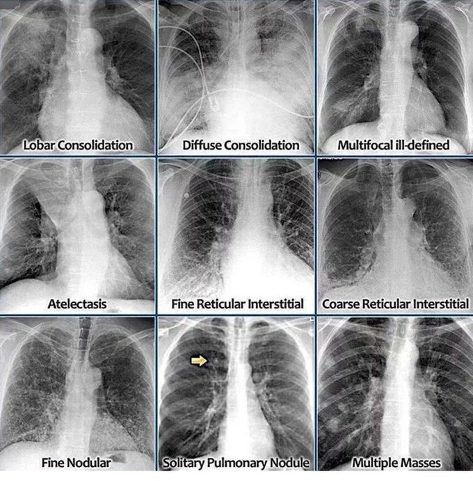 Chest X-ray