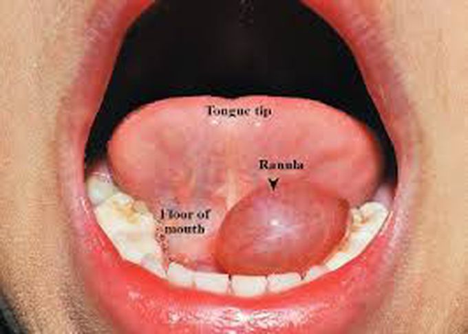 Lingual Ranula