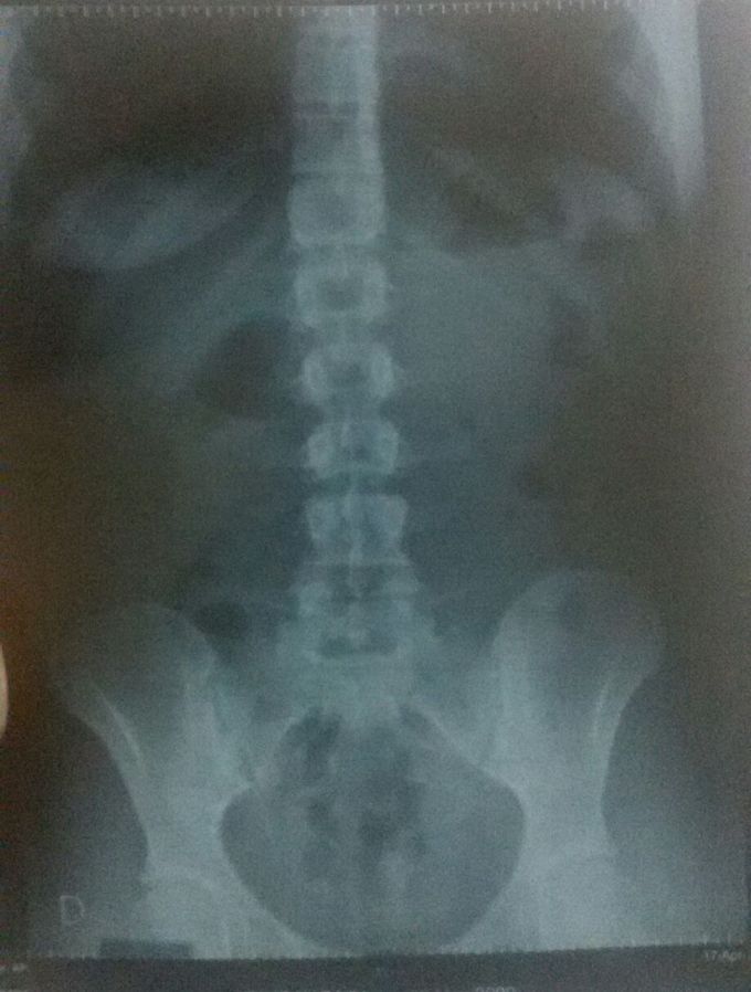 Whats wrong in this xray?