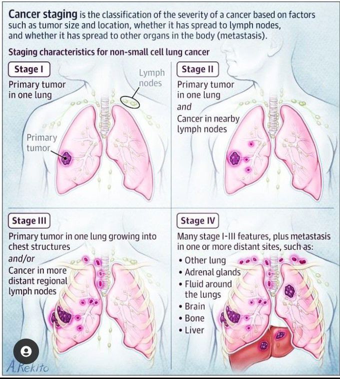 Cancer staging