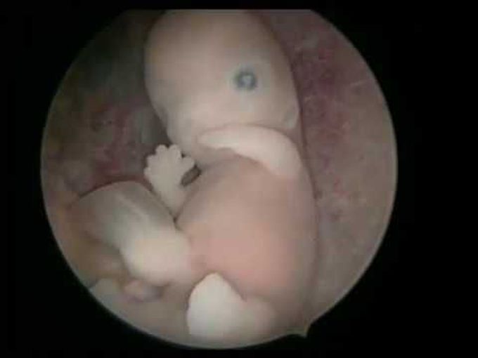 Magic of hysteroscopy: Embryoscopy the unexplored world