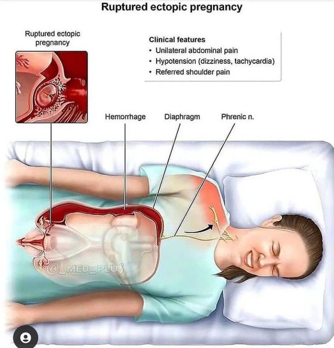 Ruptured ectopic pregnancy