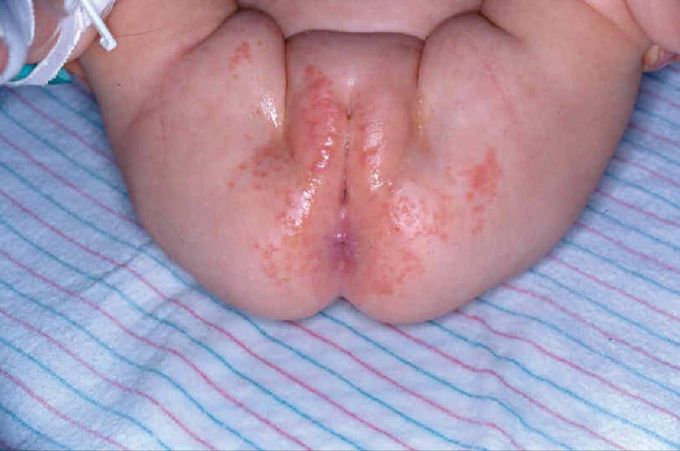 Monilial Diaper Rash