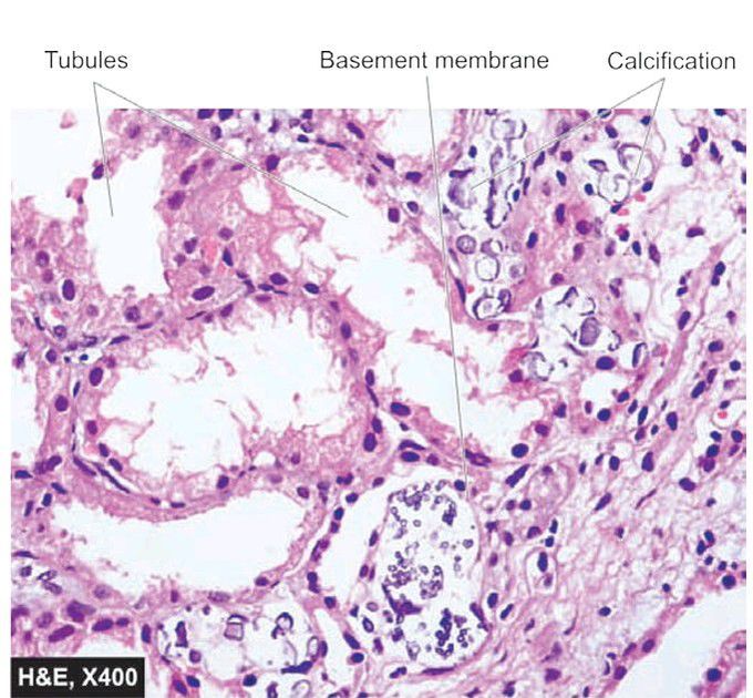 Metastatic calcification