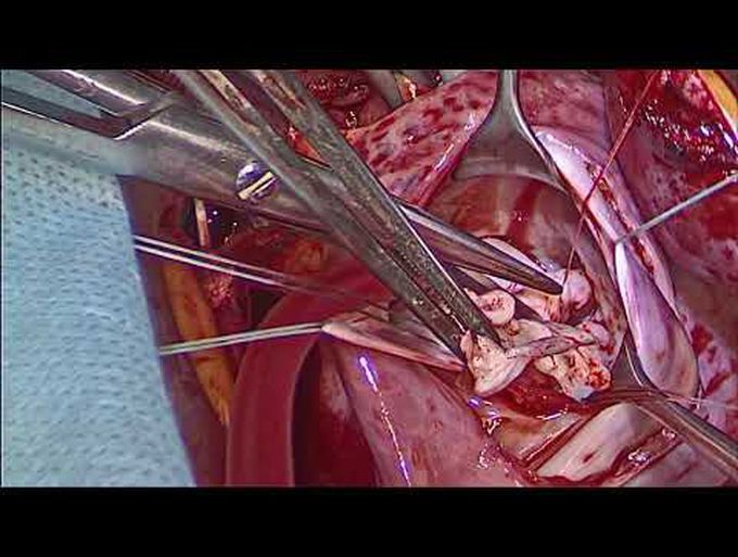 Simultaneous Mitral Valve Repair and Pectus Excavatum Correction