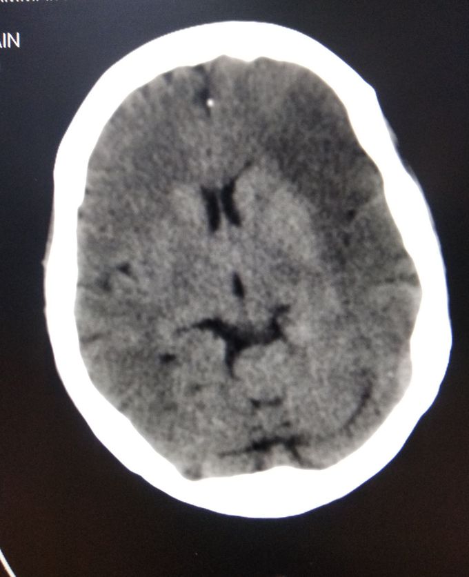 CT Brain Plane.. identify the pathology!