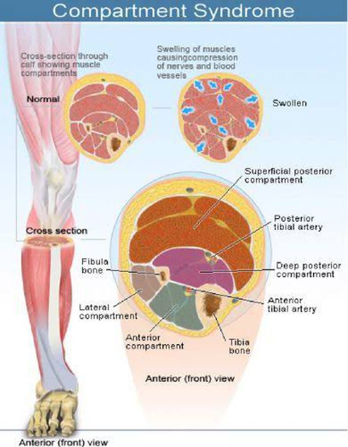 Compartment Syndrome