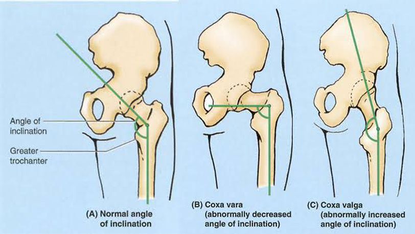 The definition of cup inclination angles and head lateral