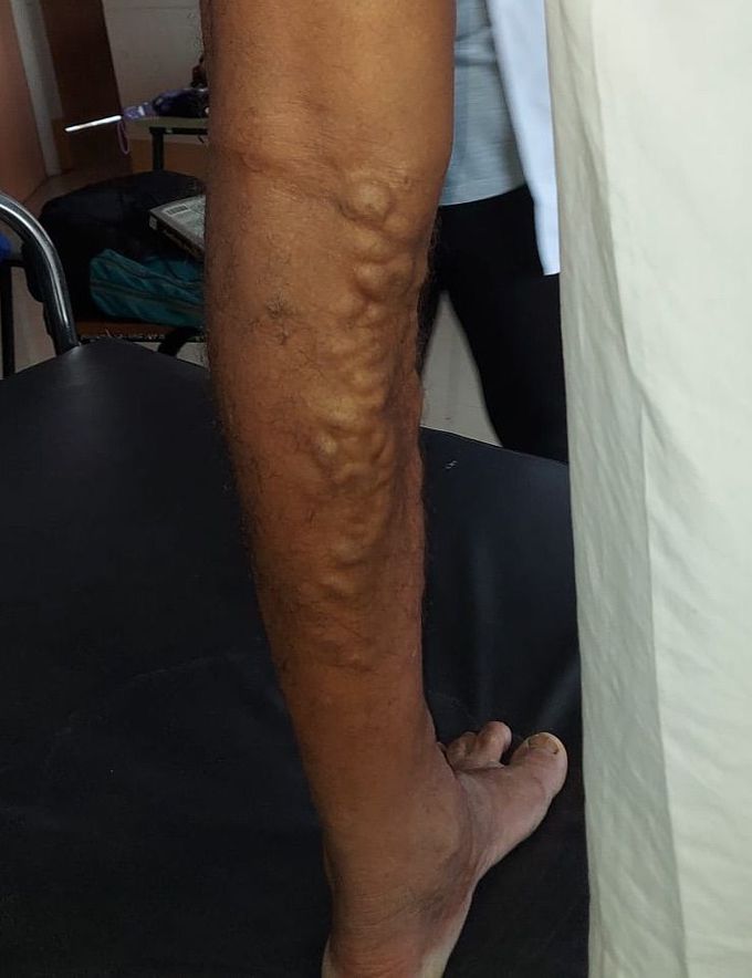 Left limb varicose veins