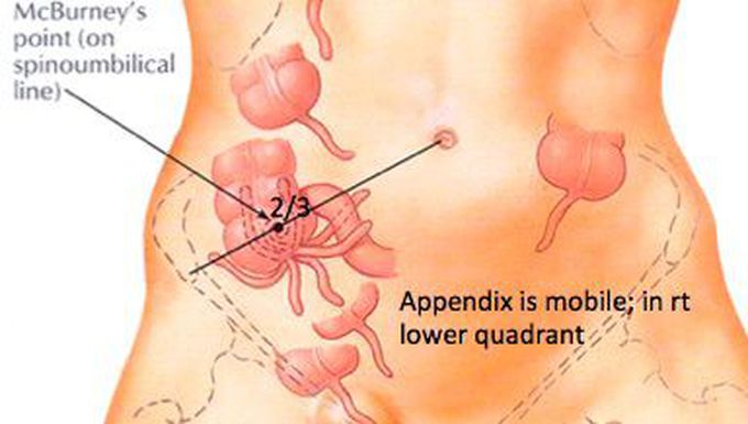 Точки аппендицита. Точка расположения аппендикса. Точка МАКБЕРНИ аппендицит.