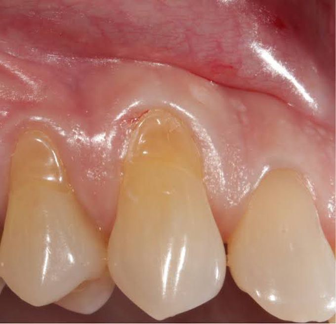 Dental abrasion