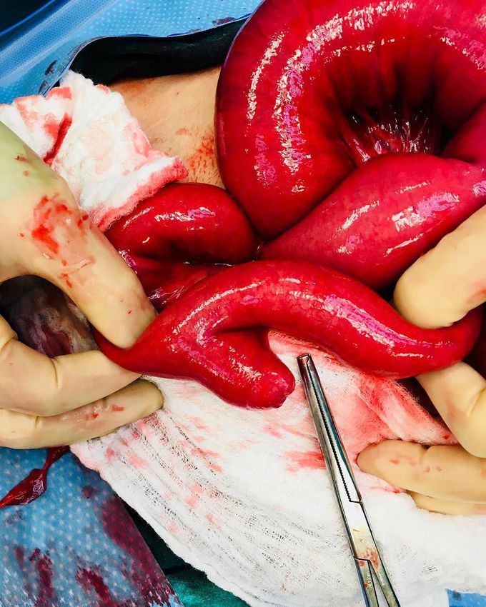 Meckel diverticulum diagnosed in an adult patient!