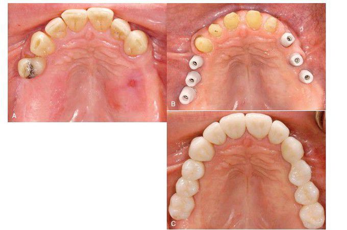 Restoration of bilateral posterior edentulous maxilla